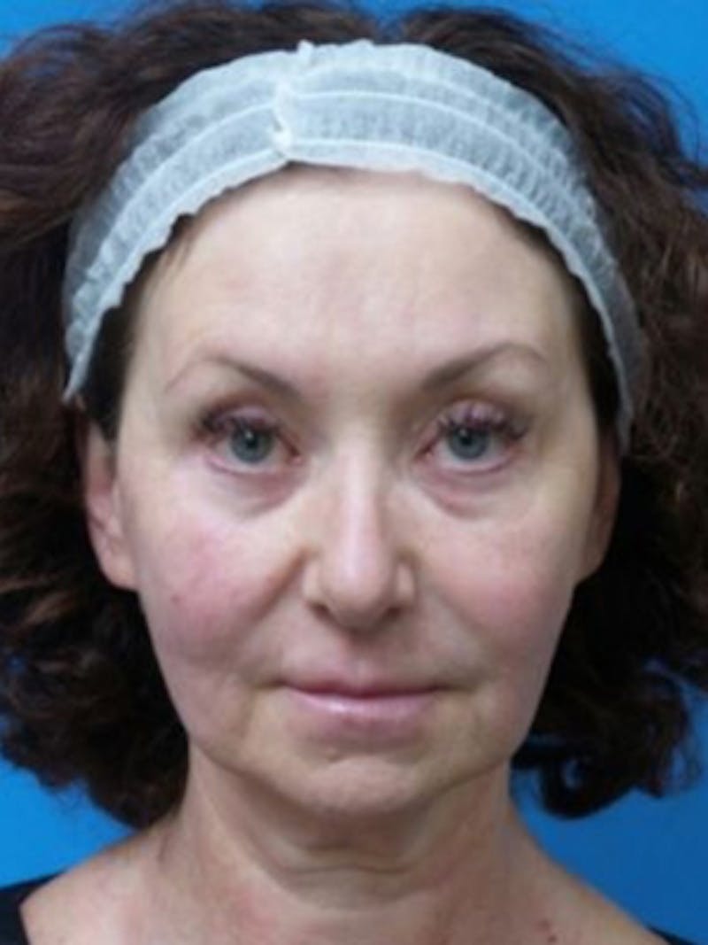 Facelift Before & After Gallery - Patient 969647 - Image 1