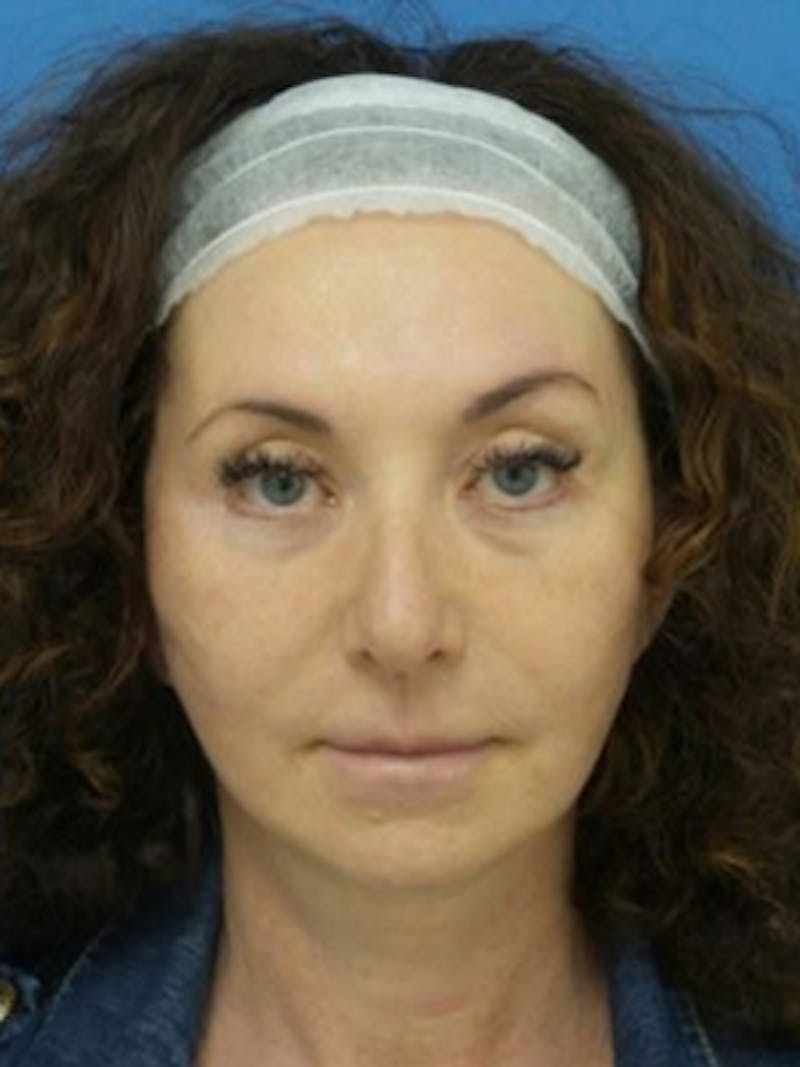 Facelift Before & After Gallery - Patient 969647 - Image 2