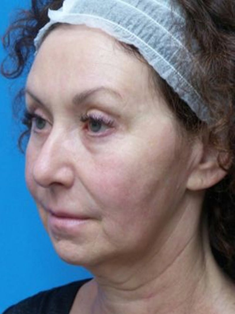 Facelift Before & After Gallery - Patient 969647 - Image 3