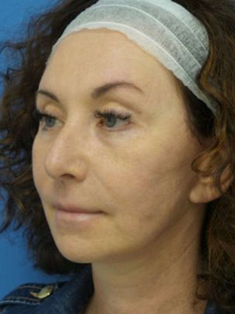 Facelift Before & After Gallery - Patient 969647 - Image 4