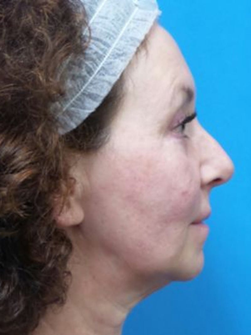 Facelift Before & After Gallery - Patient 969647 - Image 5