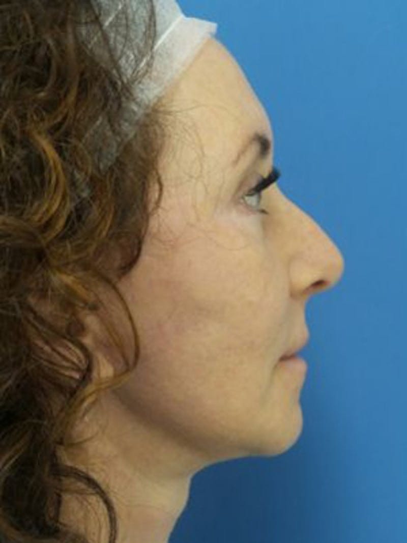 Facelift Before & After Gallery - Patient 969647 - Image 6