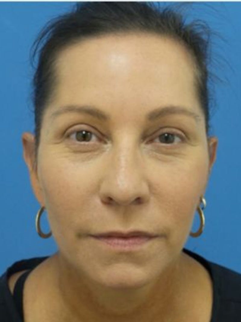 Facelift Before & After Gallery - Patient 357696 - Image 2