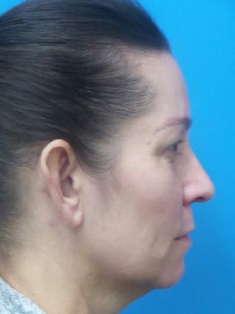 Facelift Before & After Gallery - Patient 357696 - Image 5