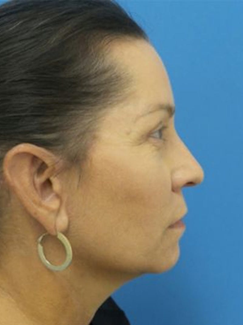 Facelift Before & After Gallery - Patient 357696 - Image 6