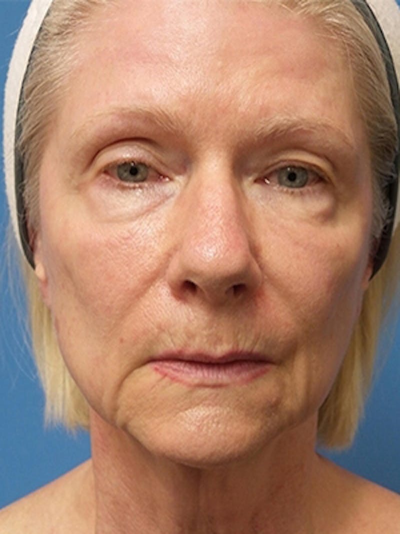 Facelift Before & After Gallery - Patient 251393 - Image 1
