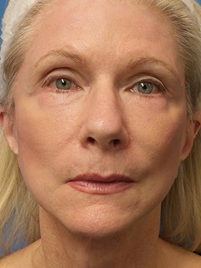 Facelift Before & After Gallery - Patient 251393 - Image 2