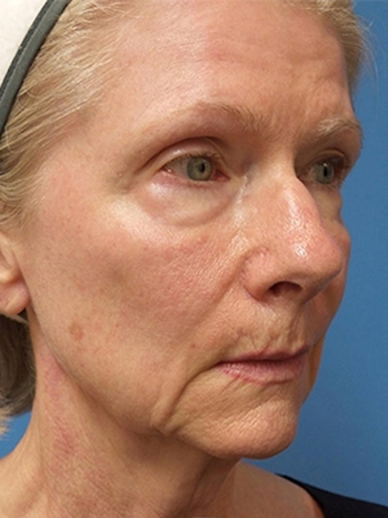 Facelift Before & After Gallery - Patient 251393 - Image 3