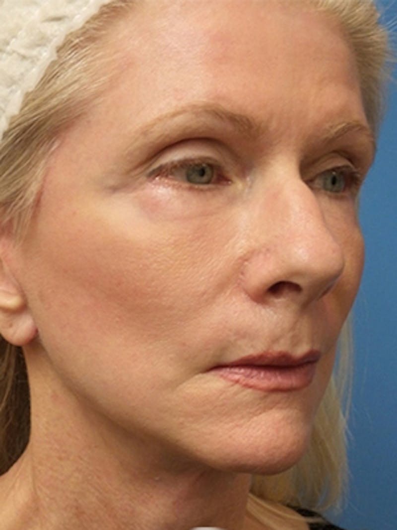 Facelift Before & After Gallery - Patient 251393 - Image 4