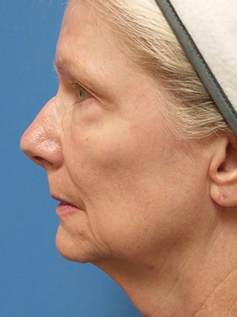 Facelift Before & After Gallery - Patient 251393 - Image 5