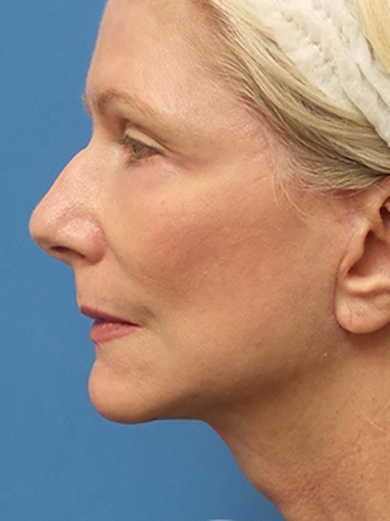 Facelift Before & After Gallery - Patient 251393 - Image 6
