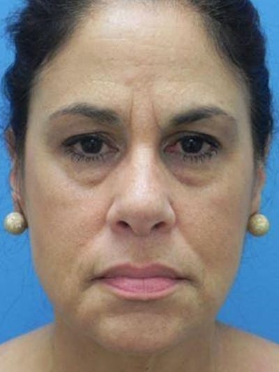 Brow Lift Before & After Gallery - Patient 113820 - Image 1