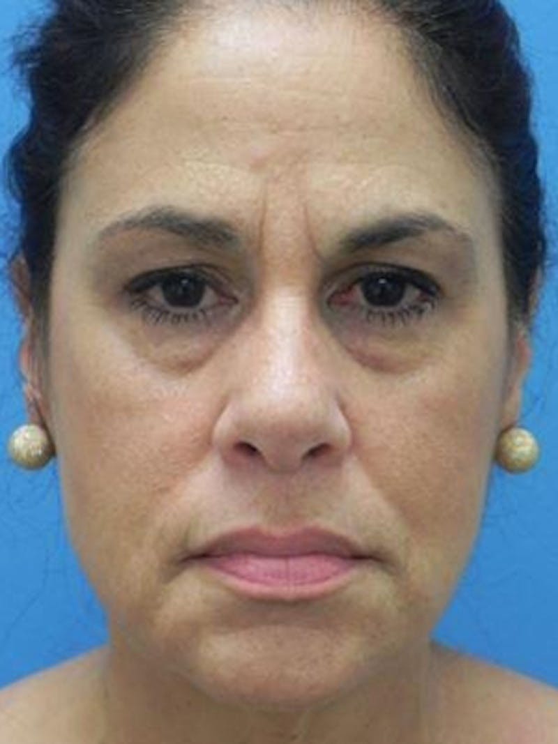 Facelift Before & After Gallery - Patient 340099 - Image 1
