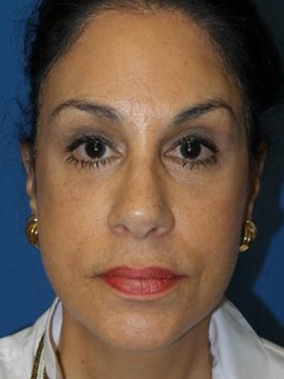 Brow Lift Before & After Gallery - Patient 113820 - Image 2