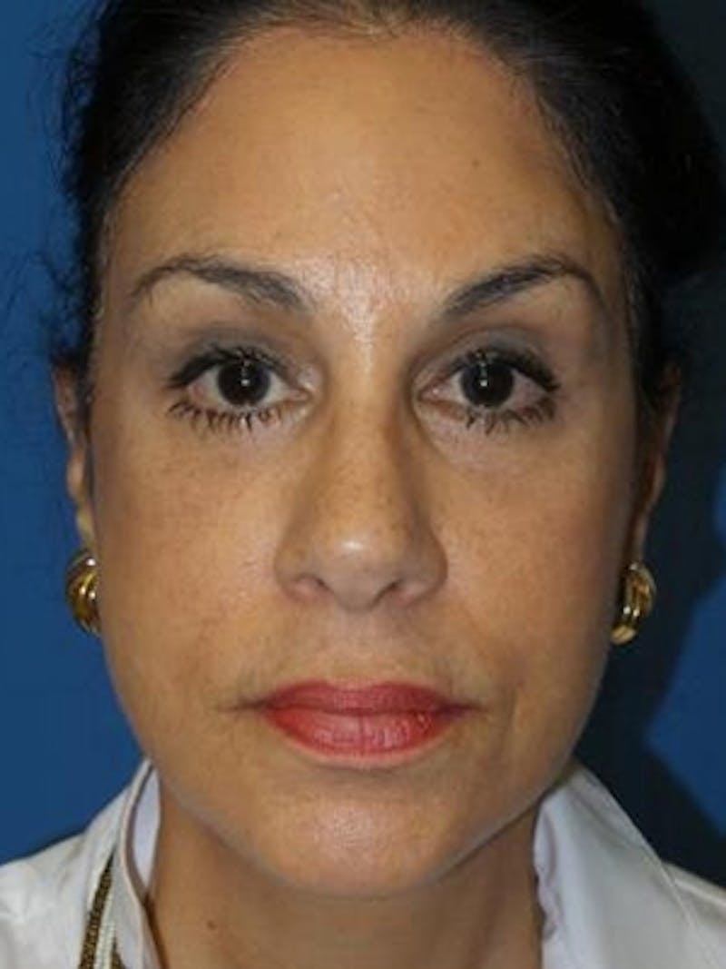Facelift Before & After Gallery - Patient 340099 - Image 2