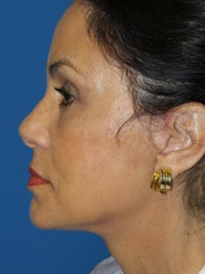 Facelift Before & After Gallery - Patient 340099 - Image 4