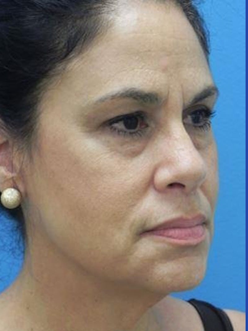 Facelift Before & After Gallery - Patient 340099 - Image 5
