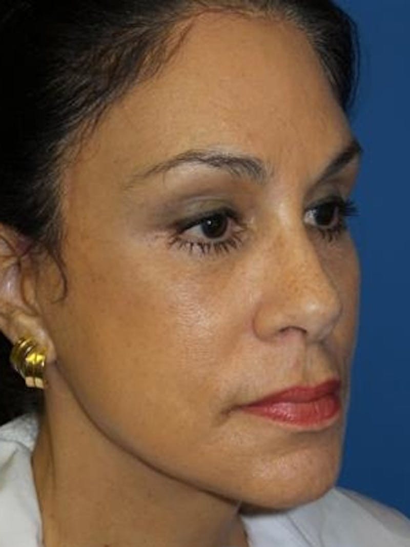 Facelift Before & After Gallery - Patient 340099 - Image 6