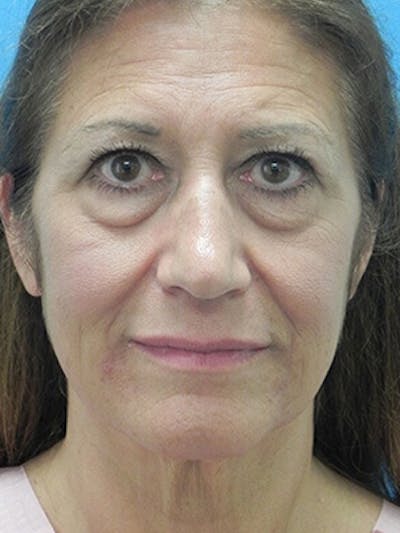 Brow Lift Before & After Gallery - Patient 284231 - Image 1