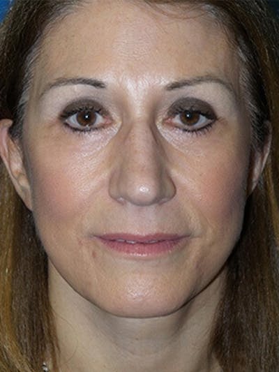 Brow Lift Before & After Gallery - Patient 284231 - Image 2