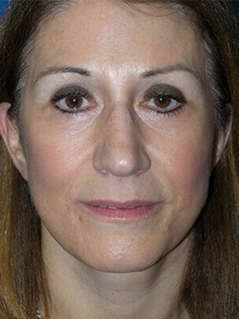 Brow Lift Before & After Gallery - Patient 284231 - Image 2