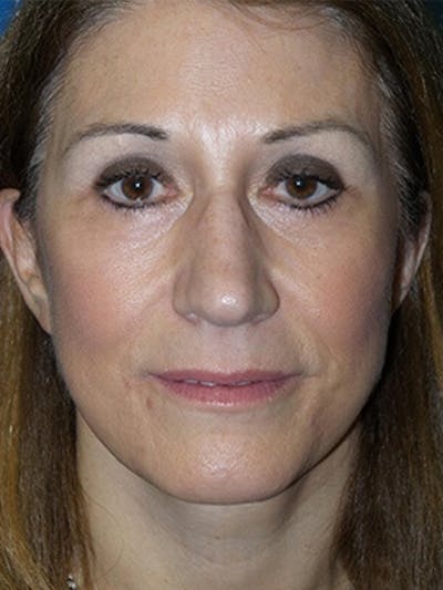 Facelift Before & After Gallery - Patient 729224 - Image 2