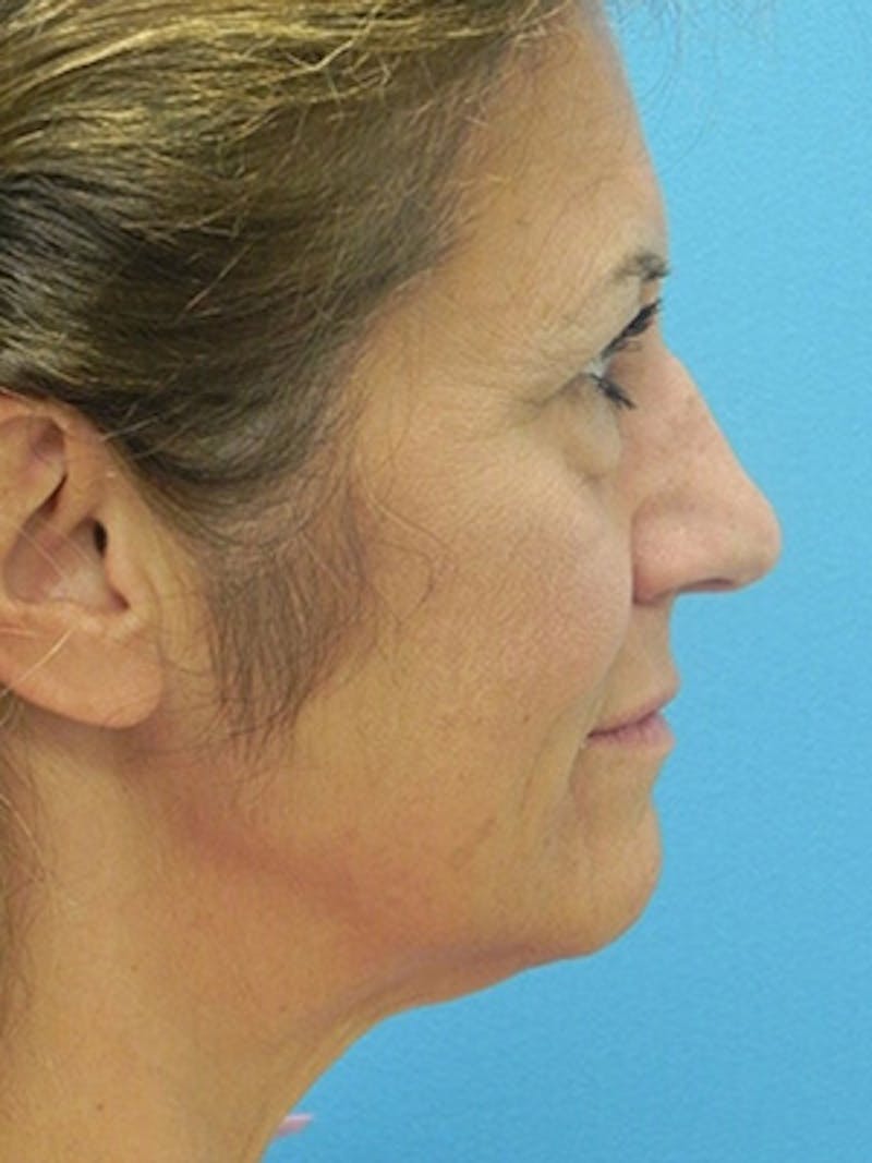 Brow Lift Before & After Gallery - Patient 284231 - Image 3