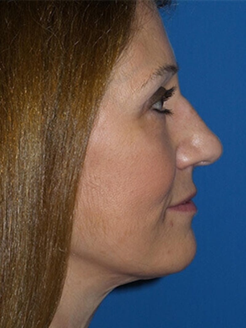Brow Lift Before & After Gallery - Patient 284231 - Image 4