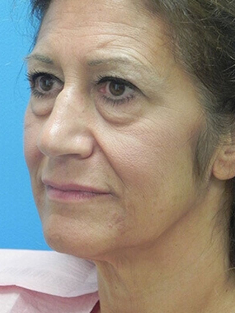 Facelift Before & After Gallery - Patient 729224 - Image 5