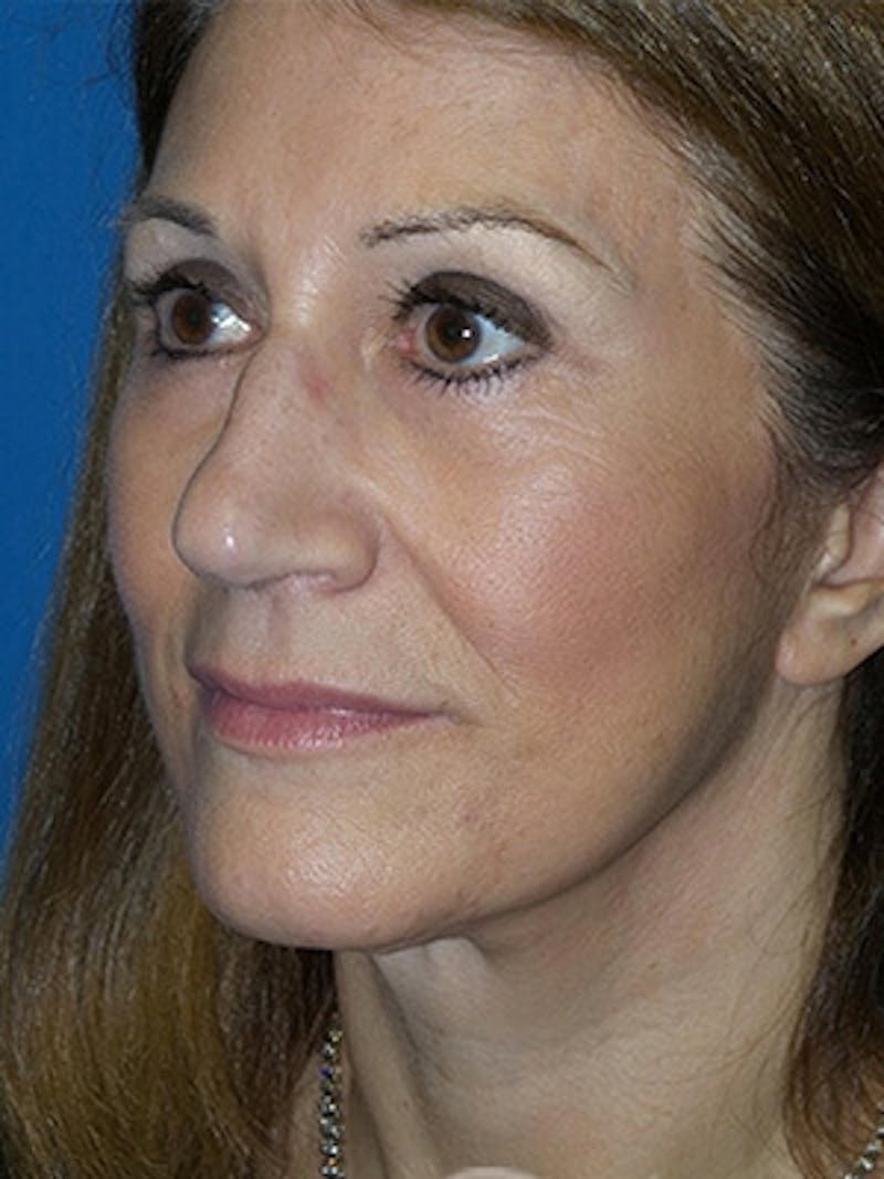Brow Lift Before & After Gallery - Patient 284231 - Image 6
