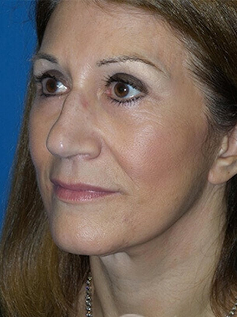 Facelift Before & After Gallery - Patient 729224 - Image 6