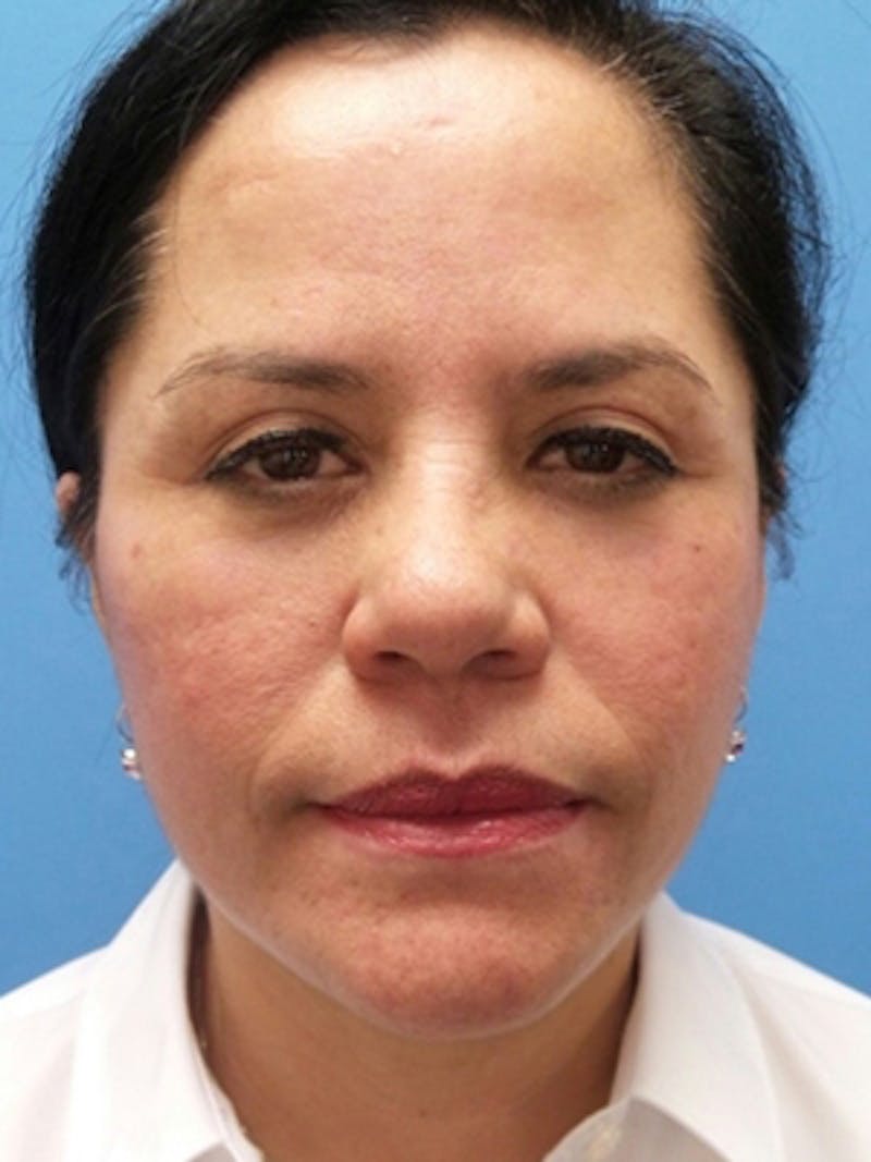 Facelift Before & After Gallery - Patient 215582 - Image 2