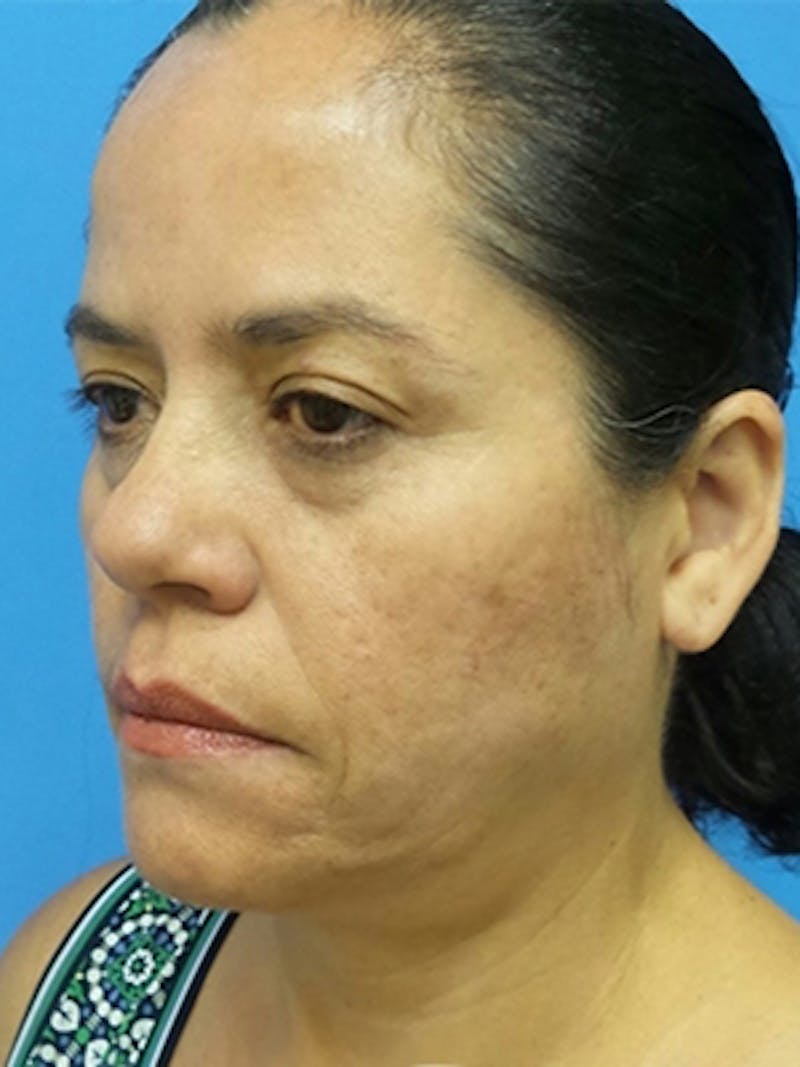 Facelift Before & After Gallery - Patient 215582 - Image 3