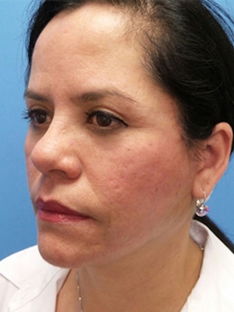 Facelift Before & After Gallery - Patient 215582 - Image 4