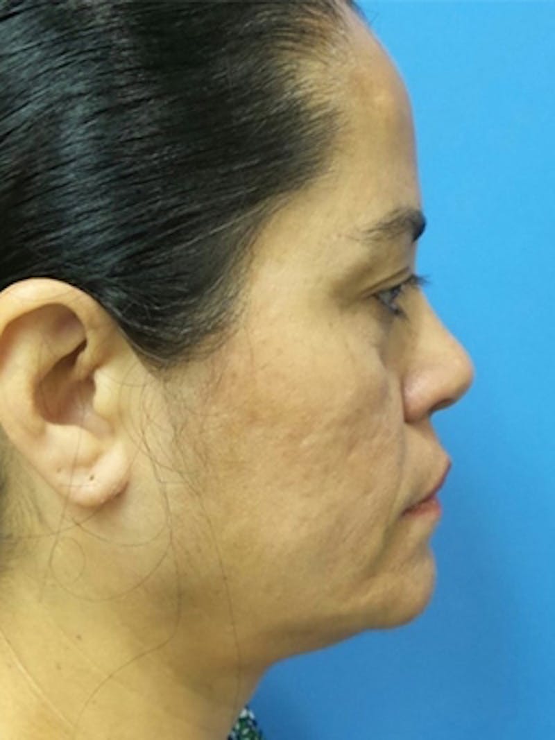 Facelift Before & After Gallery - Patient 215582 - Image 5