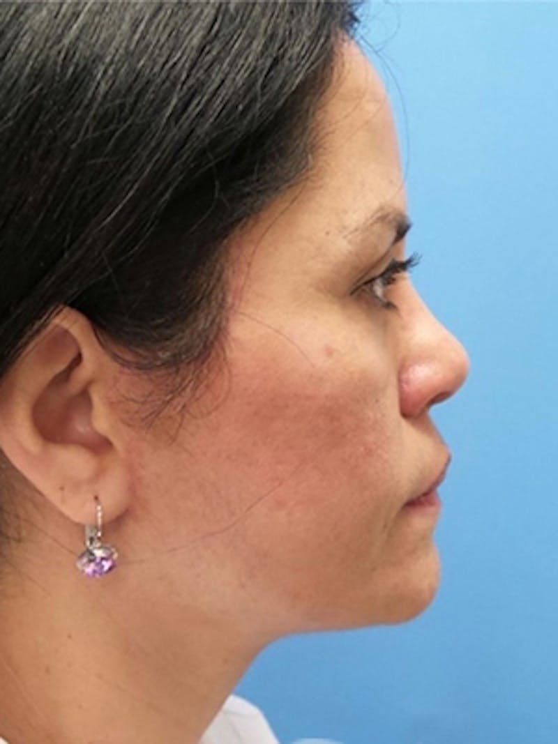Facelift Before & After Gallery - Patient 215582 - Image 6