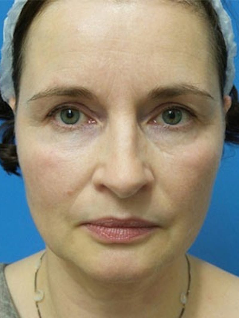Facelift Before & After Gallery - Patient 225624 - Image 1