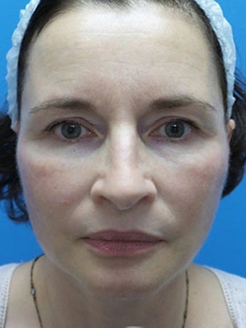 Facelift Before & After Gallery - Patient 225624 - Image 2