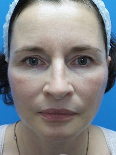 Facelift Before & After Gallery - Patient 225624 - Image 2