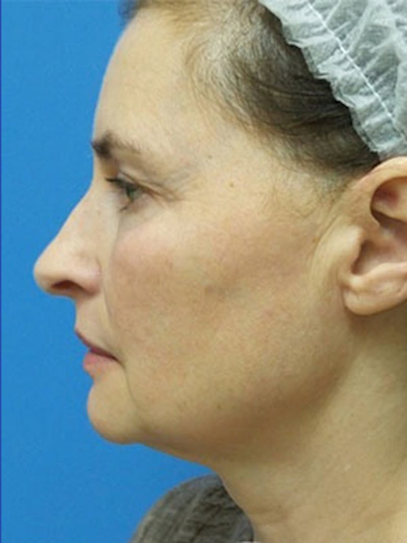 Facelift Before & After Gallery - Patient 225624 - Image 3