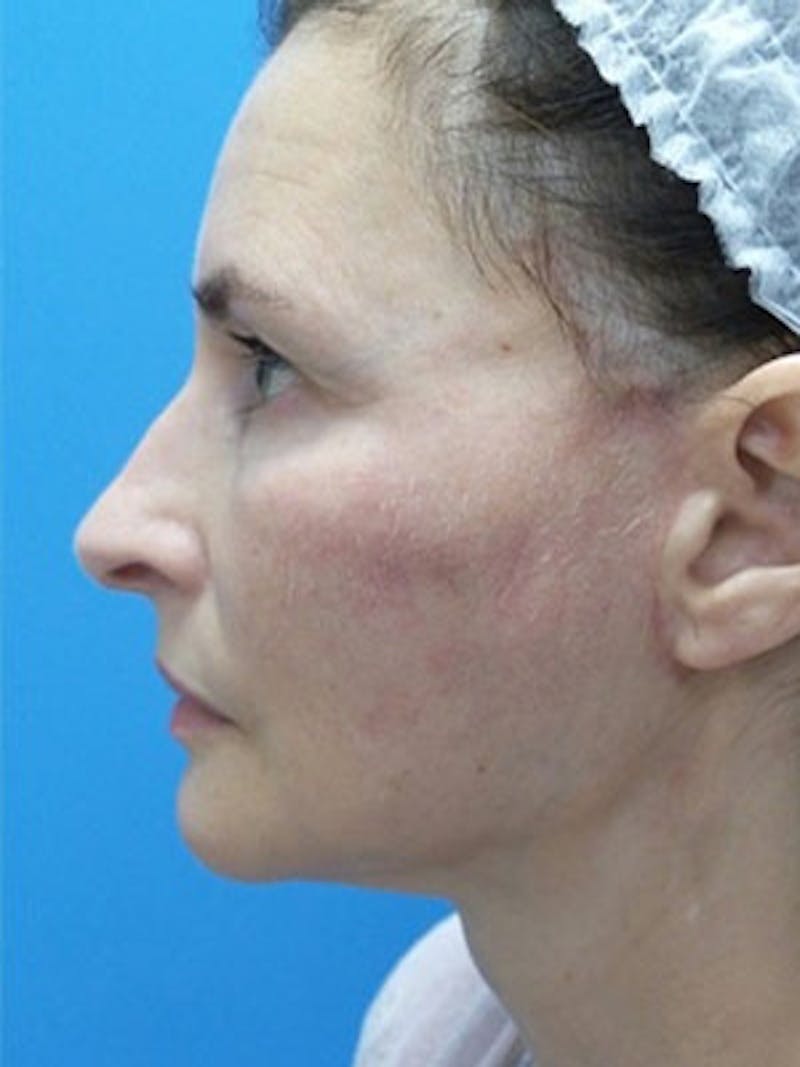Facelift Before & After Gallery - Patient 225624 - Image 4