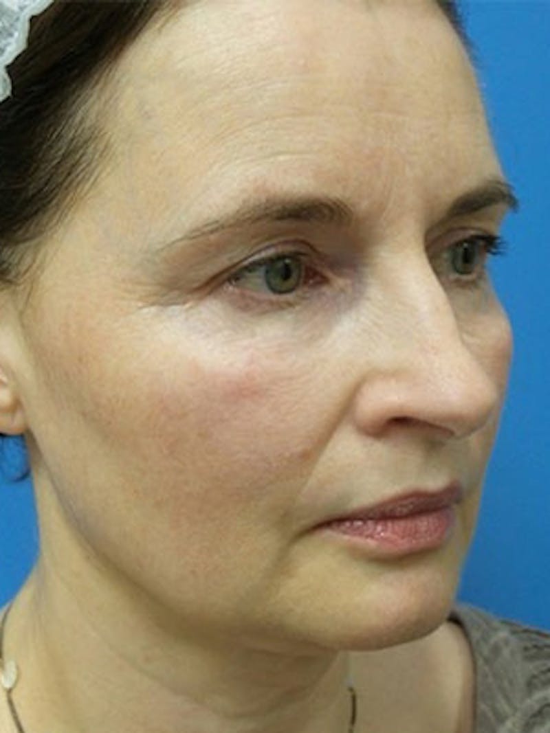 Facelift Before & After Gallery - Patient 225624 - Image 5