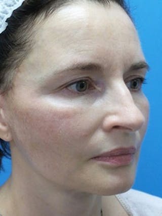Facelift Before & After Gallery - Patient 225624 - Image 6
