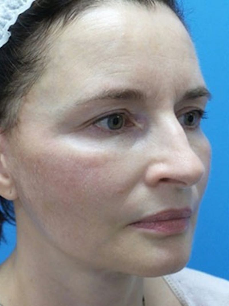 Facelift Before & After Gallery - Patient 225624 - Image 6
