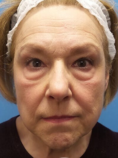 Brow Lift Before & After Gallery - Patient 403950 - Image 1