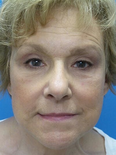Brow Lift Before & After Gallery - Patient 403950 - Image 2