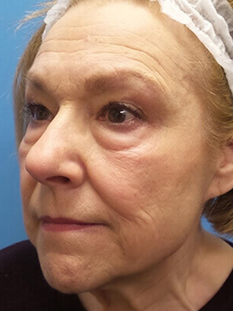 Facelift Before & After Gallery - Patient 225576 - Image 3