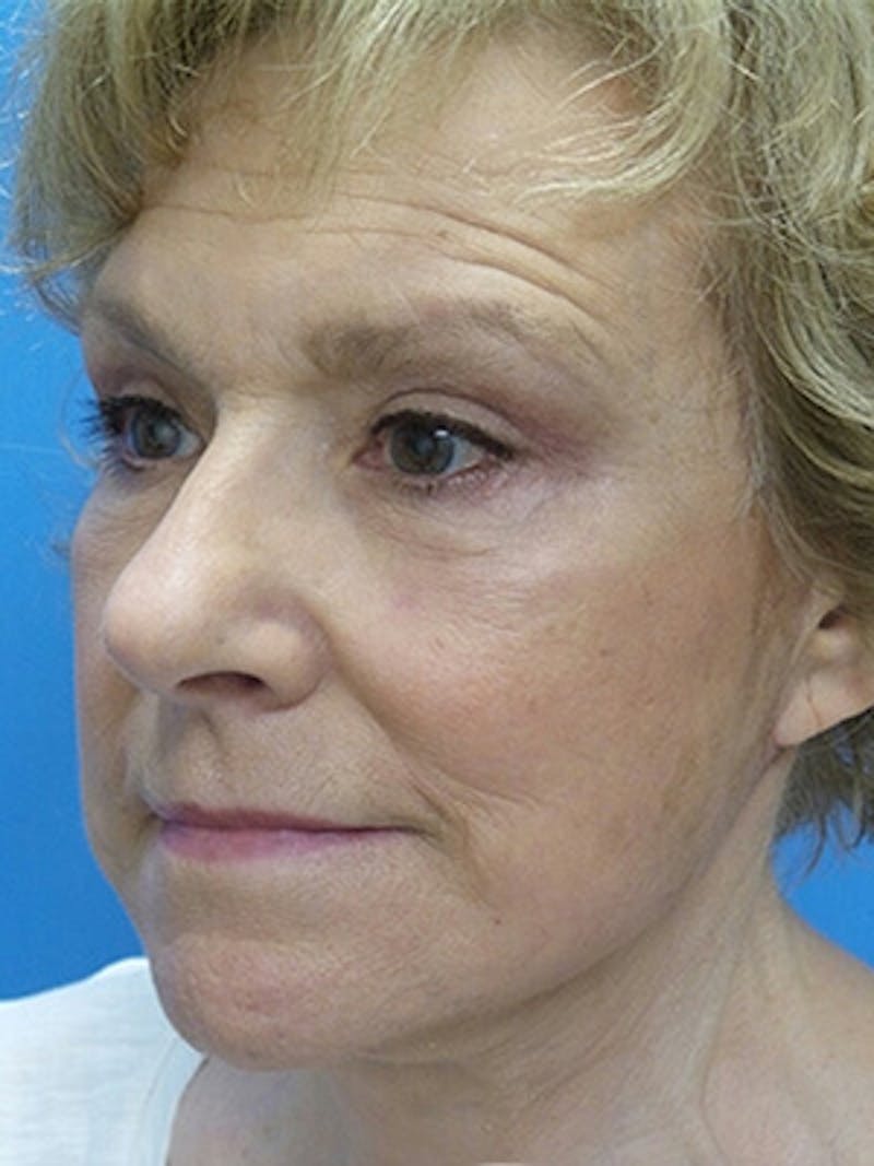 Facelift Before & After Gallery - Patient 225576 - Image 4