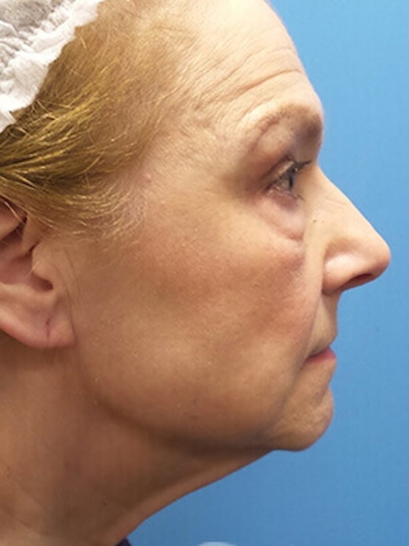 Facelift Before & After Gallery - Patient 225576 - Image 5