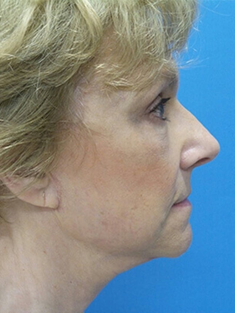 Brow Lift Before & After Gallery - Patient 403950 - Image 6